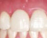 After Dental Implant